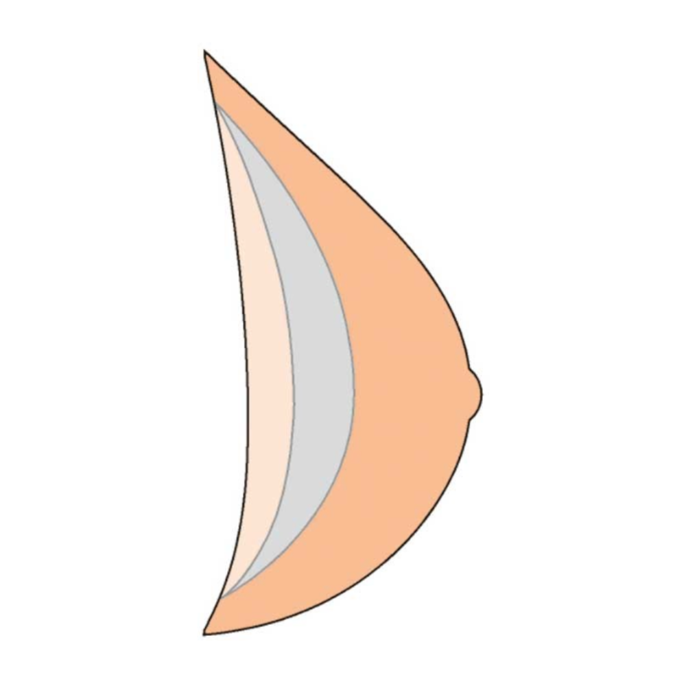 Amoena Natura Xtra Light 2S 401 Breast Form